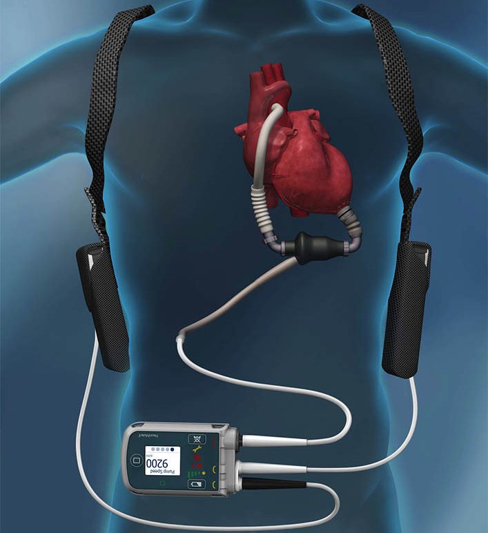 LVAD Implant Management