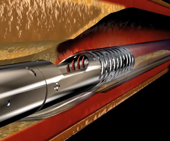 Pantheris Lumivascular Atherectomy Animation 